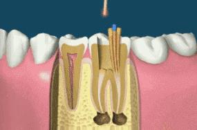 根管治疗后牙齿还能咬硬物吗,根管治疗后牙齿还能用多久