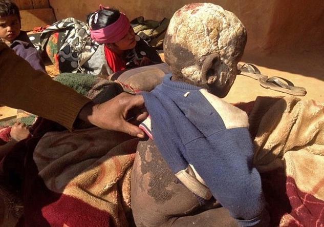 印度男孩身上长满了什么,印度11岁男孩长满鳞片