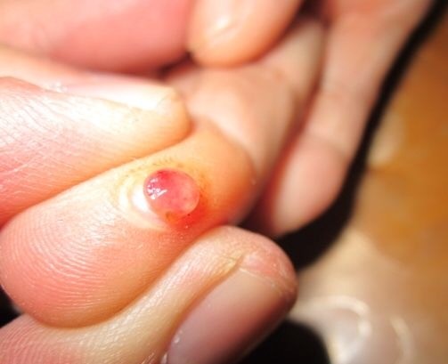 小孩脸被同学抓伤流血,孩子脸用铅笔扎了会留疤吗