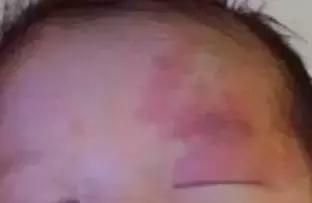 宝宝身上有5个胎记,孩子身上有10块胎记