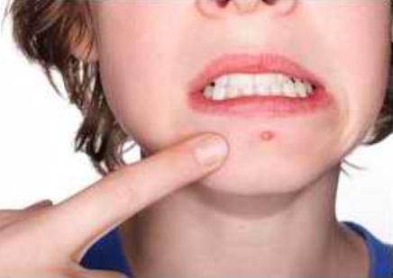 皮肤科医生建议淡化痘印的方法,顽固痘印怎么祛除医美