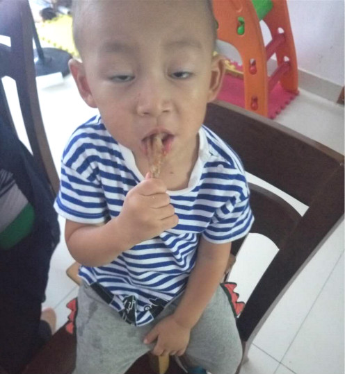 手足口病会传染成疱疹性咽峡炎吗,疱疹性咽峡炎还会感染手足口么