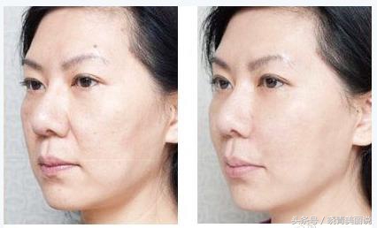 孩子刚出生就有法令纹,15岁小孩为啥有法令纹