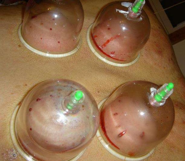 孩子艾灸为什么易上火,艾灸后很上火怎么办