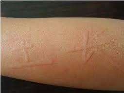 痒痒痒！得了*麻疹荨**怎么办？