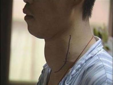 体检甲状腺有结节怎么消除,甲状腺肿大后有没有保守治疗方法