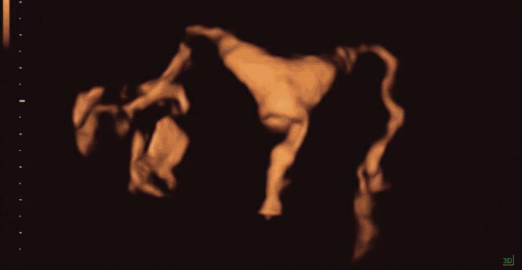 输卵管四维超声造影，不孕患者的福音