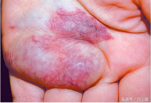 胎记原来是这样来的,你有胎记吗什么意思