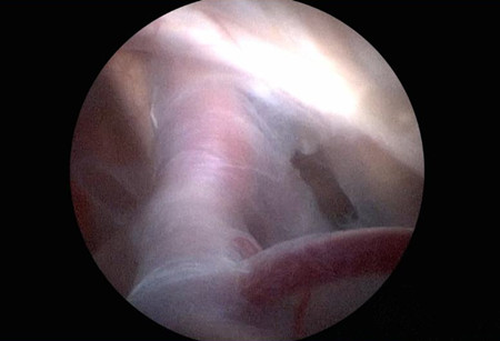 神经内镜治疗蛛网膜囊肿,颅内蛛网膜囊肿外科治疗方法