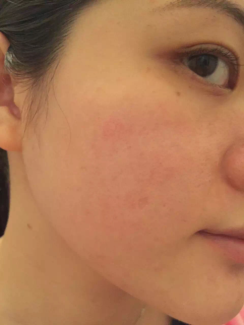 慎入！春季多发激素脸！你还要不要脸？