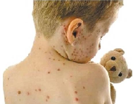 小孩得水痘了大人如何预防被传染,小孩疑似水痘怎么办