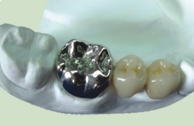 义齿知识普及,劣质义齿对身体有哪些害处