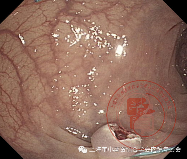 内镜套扎是什么,内镜套扎器械