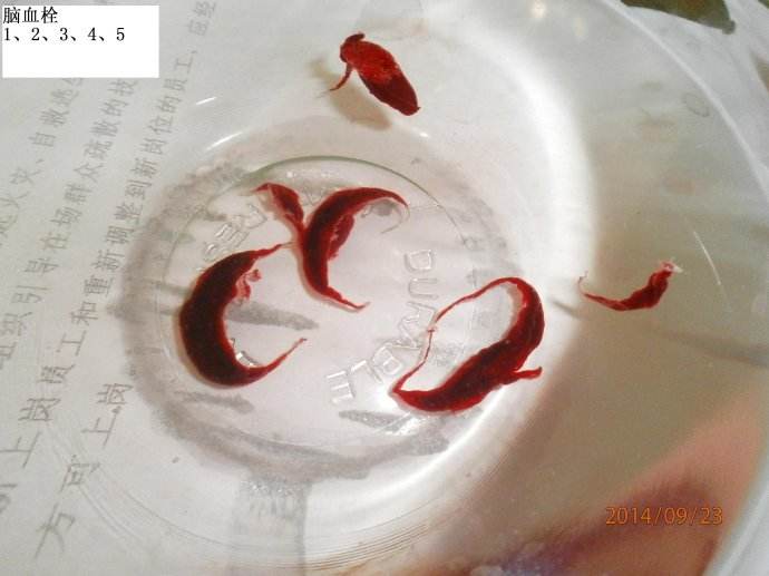 脑血栓患者语言怎么康复,脑血栓肢体无力患者怎么康复