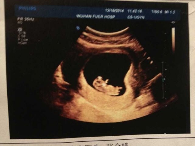 39周顺产的胎宝宝,孕39周想顺产的妈咪注意事项