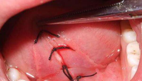 宝宝舌头w型是舌系带短吗,宝宝舌头w型一定要做手术吗