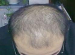 情绪不好出现皮肤病,情绪不稳定得皮肤病