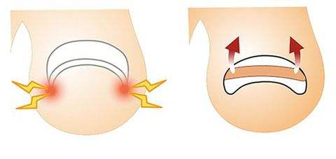 怎样把长在肉里的指甲自己弄出来,脚指甲长到肉里面了怎么剪得出来