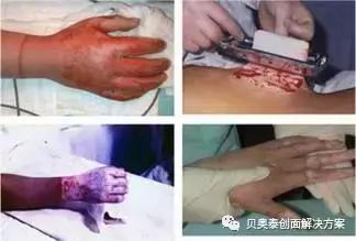 烧伤的治疗,烧伤的治疗土方