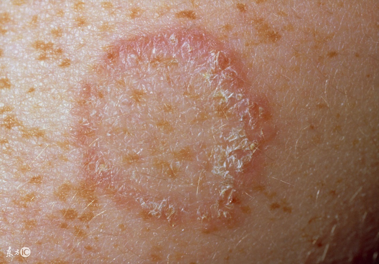 下雨天怎么防止脚水肿,香港脚要如何预防