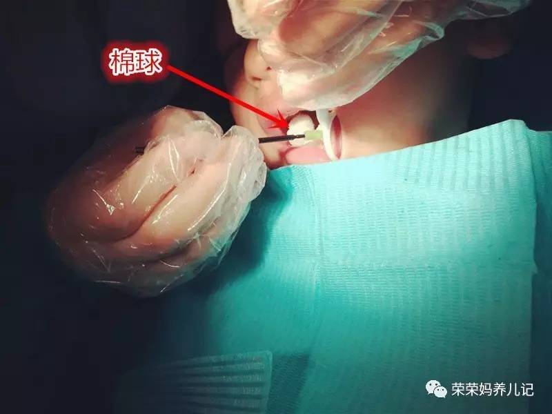 儿童涂氟前需要做口腔内窥镜吗,小孩牙齿涂氟好还是做窝沟封闭好