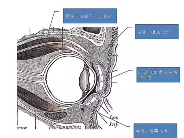 女孩戴隐形眼镜一个月未取失明,眼睛里取出来三十几片隐形眼镜