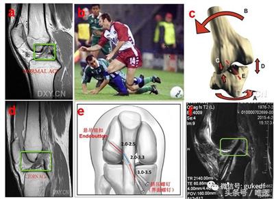 膝关节增生与滑膜炎的区别,关节炎滑膜炎骨质增生能治好吗