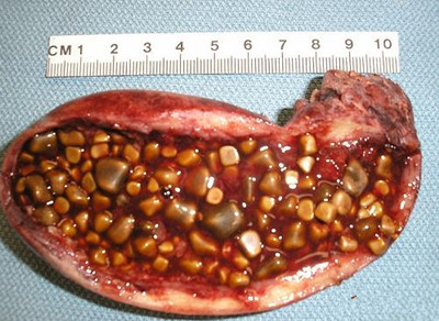 腰子含嘌呤多还是豆皮多,结石可以吃腰子吗