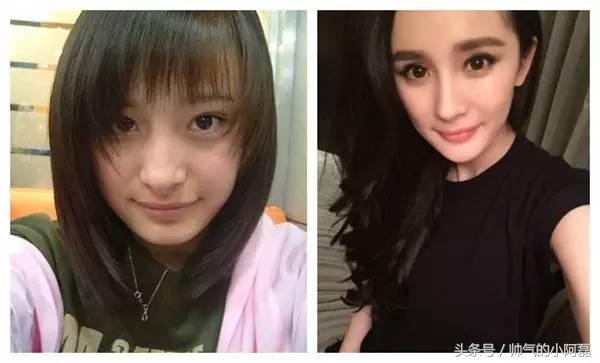 玻尿酸微整形丰下巴多少钱一针,下巴微整形要多少钱