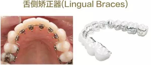 牙整形需要什么过程,整形整牙全过程