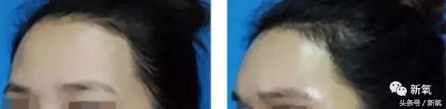 杨紫微整前后容颜对比,杨紫瘦了吗