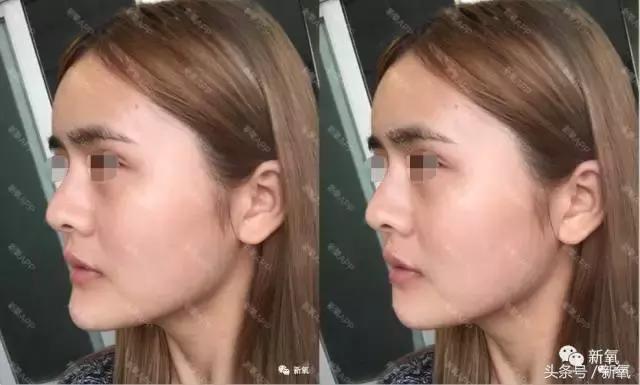 杨紫微整前后容颜对比,杨紫瘦了吗