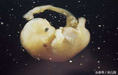 女孩医院做完流产，回家的路上大出血，孩子竟然还在肚子里