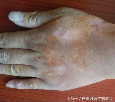 白癜风在治疗过程中白斑变红,身上长了白癜风怎么治疗
