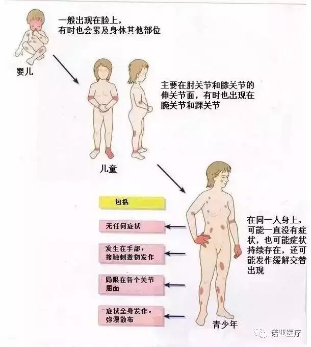 宝宝有湿疹怎么护理,宝宝湿疹破皮渗水如何护理