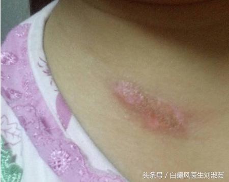 当你得了白癜风,白癜风抹药后起了水泡严重吗