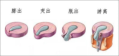 腰椎间盘突出根性症状临床表现,极外侧型腰椎间盘突出症临床表现