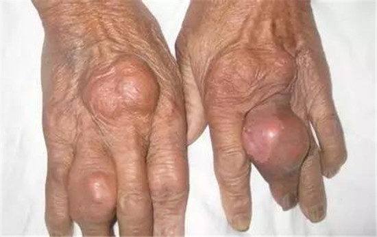 痛风未发作时降尿酸吃什么药,痛风吃什么药快速消肿止痛降尿酸