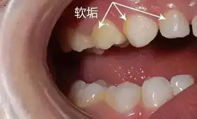 牙齿喝茶有黑色素怎样可以去掉,小朋友牙齿上的黑色素