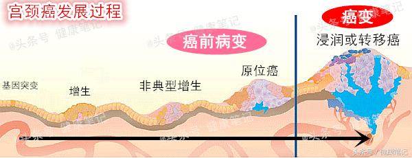宫颈癌前病变CINIII,离宫颈癌有多远?能治愈吗?