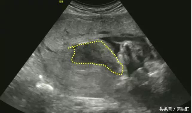 胎盘早剥诊断ppt,胎盘早剥的诊断与护理试题