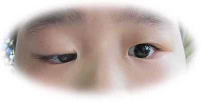 双眼皮原来这么简单自然无痕,做过的双眼皮如何看起来自然一些