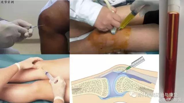 关于关节炎的疼痛肿胀是什么原因,关节炎滑膜炎疼痛难忍