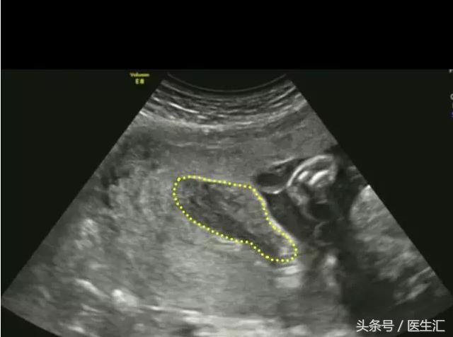 胎盘早剥是什么导致的,胎盘早剥是什么原因造成的胎儿肺炎