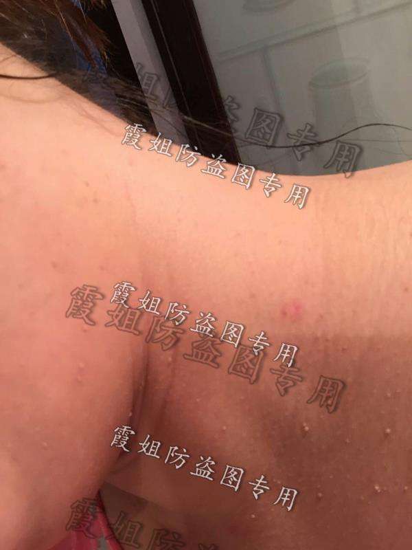 扁平疣|快去点掉你的扁平疣,别传染给我