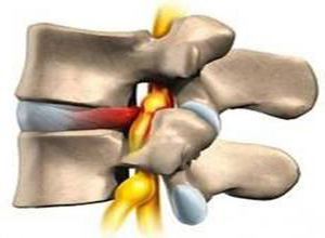 腰椎管狭窄正确康复锻炼视频,腰间盘突出椎管狭窄如何自我康复