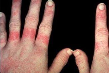 红斑狼疮记忆差怎么改善记忆,红斑狼疮如何消除皮疹