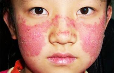 红斑狼疮怎么样算稳定期,红斑狼疮临床表现记忆口诀