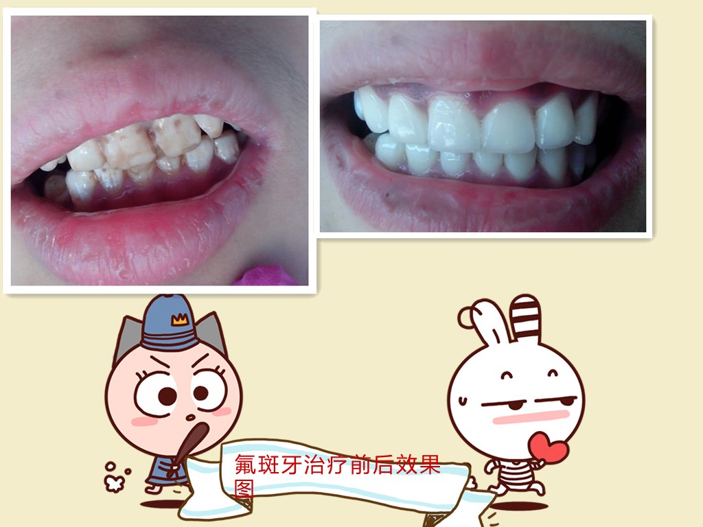 真正的烤瓷牙,烤瓷牙的真实感