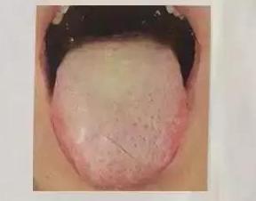 慢性咽炎喉咙痰多怎么治,慢性咽炎痰多异物感